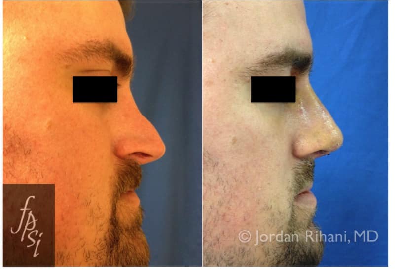 Rhinoplasty (Nose Job) Facial Plastic Surgery Institute