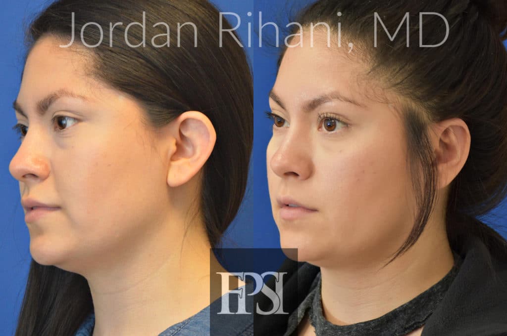 OTOPLASTY_S.L2 Facial Plastic Surgery Institute