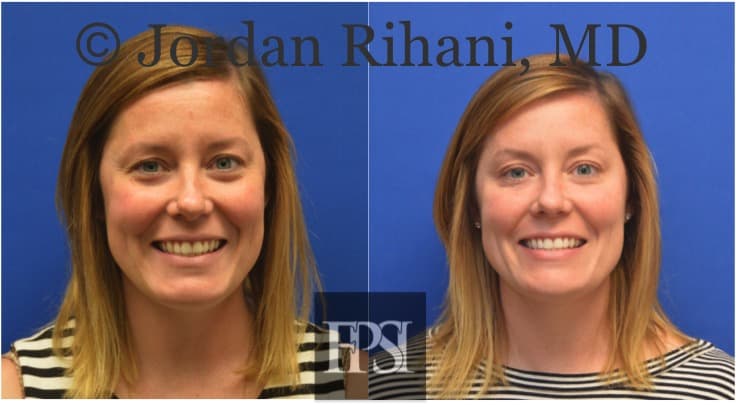 Botox Injections Keller, Southlake, Fort Worth | Facial Plastic Surgery ...