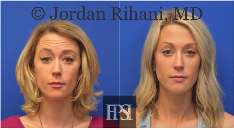 Botox Injections Keller, Southlake, Fort Worth | Facial Plastic Surgery ...