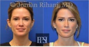 Before and after botox cheek filler by Dr. Jordan Rihani