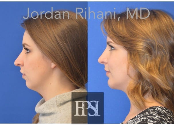 southlakechinimplant - Facial Plastic Surgery Institute