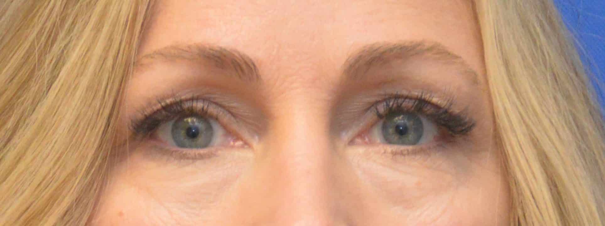 Before and after upper eye lift by Dr. Jordan Rihani