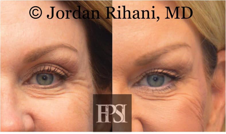 Before and after eye lift results by Dr. Jordan Rihani